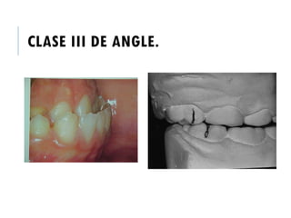 CLASE III DE ANGLE.
 