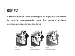 QUÉ ES?
La clasificación de la oclusión original de Angle está basada en
la relación anteroposterior entre los primeros molares
permanentes superiores e inferiores.
 
