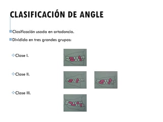 CLASIFICACIÓN DE ANGLE
Clasificación usada en ortodoncia.
Dividida en tres grandes grupos:
Clase I.
Clase II.
Clase III.
 