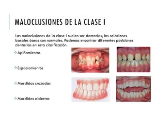 MALOCLUSIONES DE LA CLASE I
Las maloclusiones de la clase I suelen ser dentarias, las relaciones
basales óseas son normales. Podemos encontrar diferentes posiciones
dentarias en esta clasificación.
Apiñamientos
Espaciamientos
Mordidas cruzadas
Mordidas abiertas
 