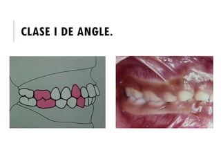 CLASE I DE ANGLE.
 
