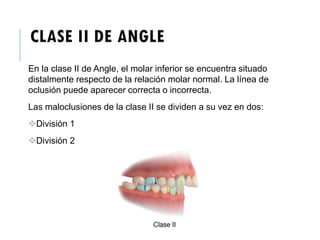 CLASE II DE ANGLE
En la clase II de Angle, el molar inferior se encuentra situado
distalmente respecto de la relación molar normal. La línea de
oclusión puede aparecer correcta o incorrecta.
Las maloclusiones de la clase II se dividen a su vez en dos:
División 1
División 2
 