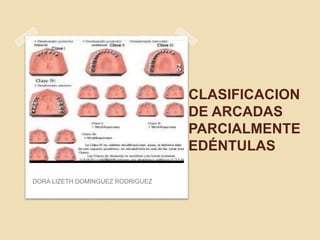 CLASIFICACION 
DE ARCADAS 
PARCIALMENTE 
EDÉNTULAS 
DORA LIZETH DOMINGUEZ RODRIGUEZ 
 