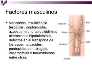 Factores masculinos
 Varicocele, insuficiencia
testicular , criptorquidia,
azoospermia, orquiepididimitis,
alteraciones hipotalámicas,
defectos en el transporte de
los espermatozoides
producidos por: cirugías,
vasectomías o traumatismos;
entre otras.
 