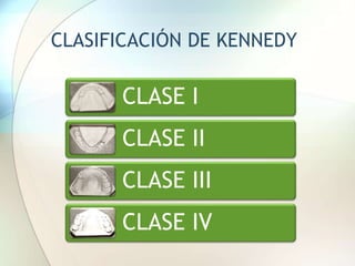 CLASIFICACIÓN DE KENNEDY
CLASE I
CLASE II
CLASE III
CLASE IV
 