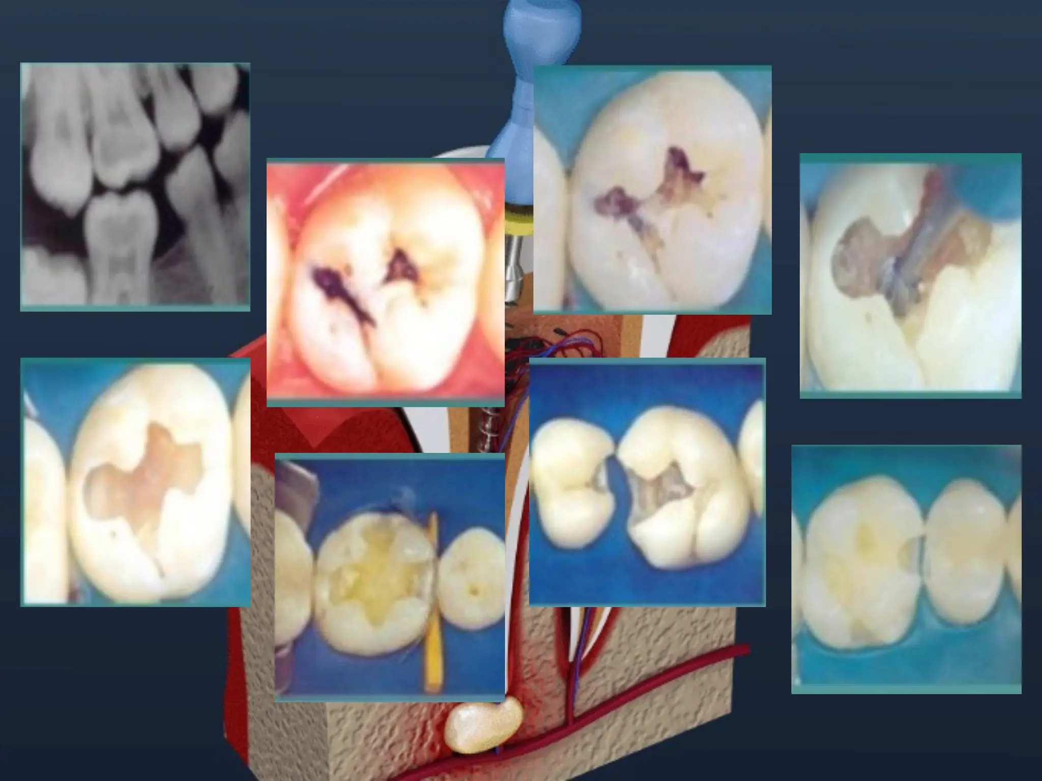 Clasificación de la patología pulpar y periapical según la AAE (1).pdf
