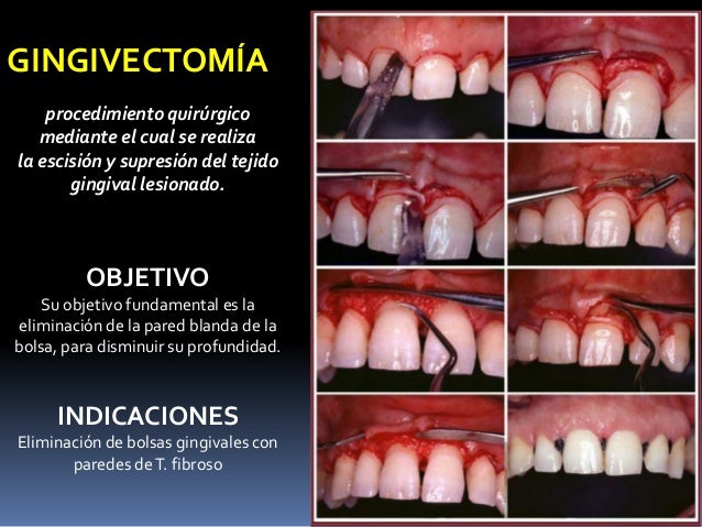 Clasificacion De Las Bolsas Periodontales Y Sondeo Periodontal 2