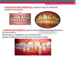 SEGÚN EL TIPO DE ENCÍA QUE
AFECTE
1. GINGIVITIS MARGINAL: afecta al margen gingival de los dientes,
pudiendo incluir a la ...