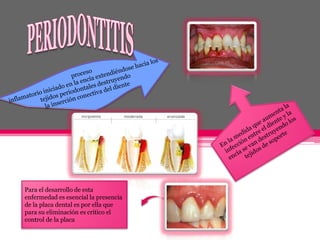 Clasificacion de las enferemedades periodontales-GINGIVITIS