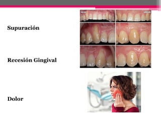 Clasificacion de las enferemedades periodontales-GINGIVITIS