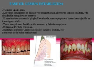 CLASIFICACION DE LA GINGIVITIS
La gingivitis se puede clasificar según su curso, su localización y
estado.
SEGÚN SU CURSO:...