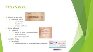 Otras Suturas
 Dispositivo Mecanico
 Grapas con gancho
 Acero inoxidable
 Ahorra tiempo
 Menos tasa de infeccion
 Cintas Adhesivas
 Steri-Strips
 Unen piel en heridas o cortes semiprofundos
 Facilita cicatrizacion
 Mejor estetica de la cicatriz
 Adhesivo Tisular
 Dermabond
 Adhesivo polimerizado que forma capa flexible en la superficie
 