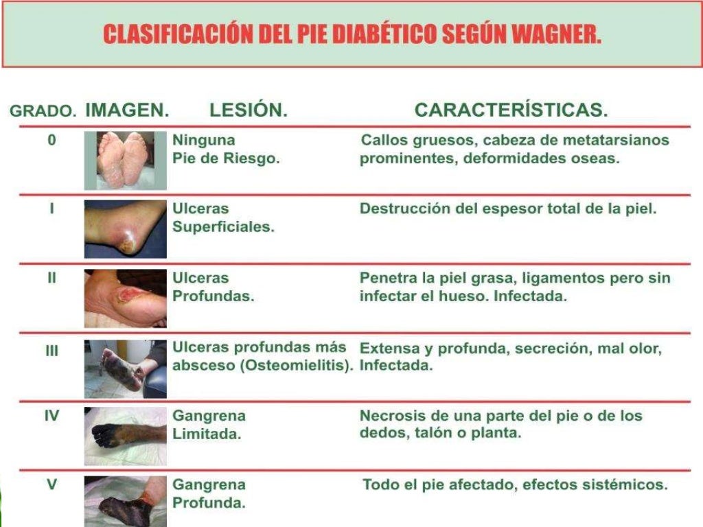 Clasificacion del pie diabetico