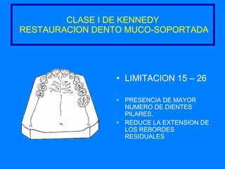 CLASE I DE KENNEDY  RESTAURACION DENTO MUCO-SOPORTADA LIMITACION 15 – 26 PRESENCIA DE MAYOR NUMERO DE DIENTES PILARES. REDUCE LA EXTENSION DE LOS REBORDES RESIDUALES 