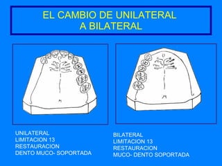 EL CAMBIO DE UNILATERAL  A BILATERAL UNILATERAL LIMITACION 13 RESTAURACION  DENTO MUCO- SOPORTADA BILATERAL LIMITACION 13 RESTAURACION  MUCO- DENTO SOPORTADA 