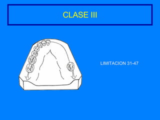 CLASE III LIMITACION 31-47 