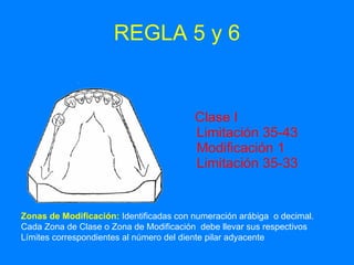 REGLA 5 y 6 Clase I  Limitación 35-43 Modificación 1 Limitación 35-33 Zonas de Modificación:   Identificadas con numeración arábiga  o decimal.  Cada Zona de Clase o Zona de Modificación  debe llevar sus respectivos Límites correspondientes al número del diente pilar adyacente  