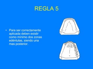 REGLA 5 Para ser correctamente aplicada deben existir como mínimo dos zonas edéntulas, siendo una mas posterior.  