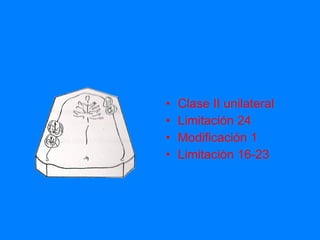 Clase II unilateral Limitación 24 Modificación 1 Limitación 16-23 