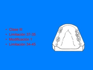 Clase III Limitación 37-35 Modificación 1 Limitación 34-45 