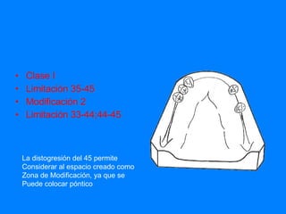 Clase I  Limitación 35-45 Modificación 2 Limitación 33-44;44-45 La distogresión del 45 permite Considerar al espacio creado como  Zona de Modificación, ya que se  Puede colocar póntico 