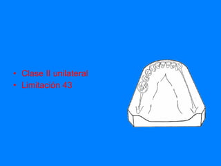 Clase II unilateral Limitación 43 