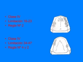 Clase IV Limitación 16-23 Regla Nº 2 Clase IV Limitación 34-47 Regla Nº 4 y 2 