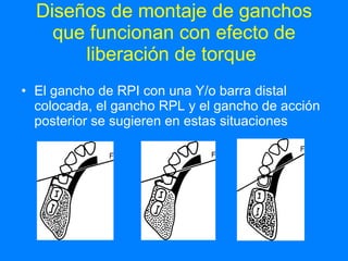 Diseños de montaje de ganchos que funcionan con efecto de liberación de torque  El gancho de RPI con una Y/o barra distal colocada, el gancho RPL y el gancho de acción posterior se sugieren en estas situaciones  