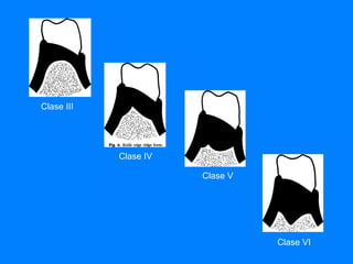 Clase III Clase IV Clase V Clase VI 