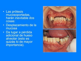 Las prótesis mucosoportadas, harán inevitable dos cosas: Desplazamiento de la mucosa Da lugar a pérdida adicional de hueso alveolar (esto es quizás lo de mayor importancia). 