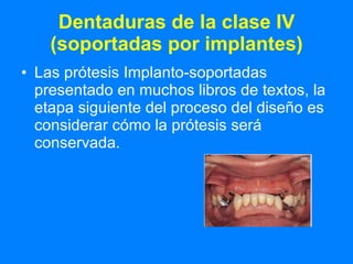 Dentaduras de la clase IV (soportadas por implantes) Las prótesis Implanto-soportadas presentado en muchos libros de textos, la etapa siguiente del proceso del diseño es considerar cómo la prótesis será conservada. 