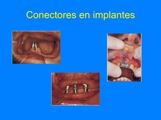 Conectores en implantes 