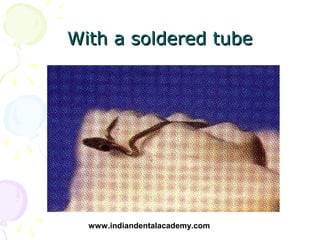 With a soldered tube




  www.indiandentalacademy.com
 