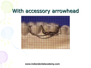 With accessory arrowhead




    www.indiandentalacademy.com
 
