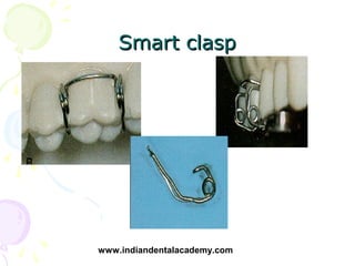 Smart clasp




www.indiandentalacademy.com
 