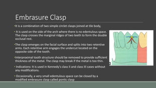 Embrasure Clasp
•It is a combination of two simple circlet clasps joined at tile body,
• It is used on the side of the arch where there is no edentulous space.
The clasp crosses the marginal ridges of two teeth to form the double
occlusal rest.
•The clasp emerges on the facial surface and splits into two retentive
arms. Each retentive arm engages the undercut located on the
opposite side of the tooth.
•Interproximal tooth structure should be removed to provide sufficient
thickness of the metal. The clasp may break if the metal is too thin.
• Indications: It is used in Kennedy's class II and class III cases without
any modifications.
• Occasionally, a very small edentulous space can be closed by a
modified embrasure clasp called pontic clasp
 