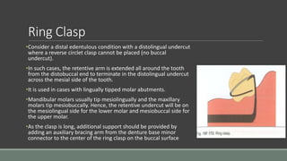 Ring Clasp
•Consider a distal edentulous condition with a distolingual undercut
where a reverse circlet clasp cannot be placed (no buccal
undercut).
•In such cases, the retentive arm is extended all around the tooth
from the distobuccal end to terminate in the distolingual undercut
across the mesial side of the tooth.
•It is used in cases with lingually tipped molar abutments.
•Mandibular molars usually tip mesiolingually and the maxillary
molars tip mesiobuccally. Hence, the retentive undercut will be on
the mesiolingual side for the lower molar and mesiobuccal side for
the upper molar.
•As the clasp is long, additional support should be provided by
adding an auxiliary bracing arm from the denture base minor
connector to the center of the ring clasp on the buccal surface
 
