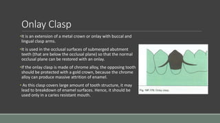 Onlay Clasp
•It is an extension of a metal crown or onlay with buccal and
lingual clasp arms.
•It is used in the occlusal surfaces of submerged abutment
teeth (that are below the occlusal plane) so that the normal
occlusal plane can be restored with an onlay.
•If the onlay clasp is made of chrome alloy, the opposing tooth
should be protected with a gold crown, because the chrome
alloy can produce massive attrition of enamel.
• As this clasp covers large amount of tooth structure, it may
lead to breakdown of enamel surfaces. Hence, it should be
used only in a caries resistant mouth.
 