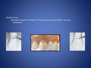 2)Outline form:
a)Roughly trapezoid in Gingival 1/3rd (Location of carious defect ; Previous
restoration).