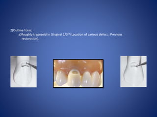 2)Outline form:
a)Roughly trapezoid in Gingival 1/3rd (Location of carious defect ; Previous
restoration).
 