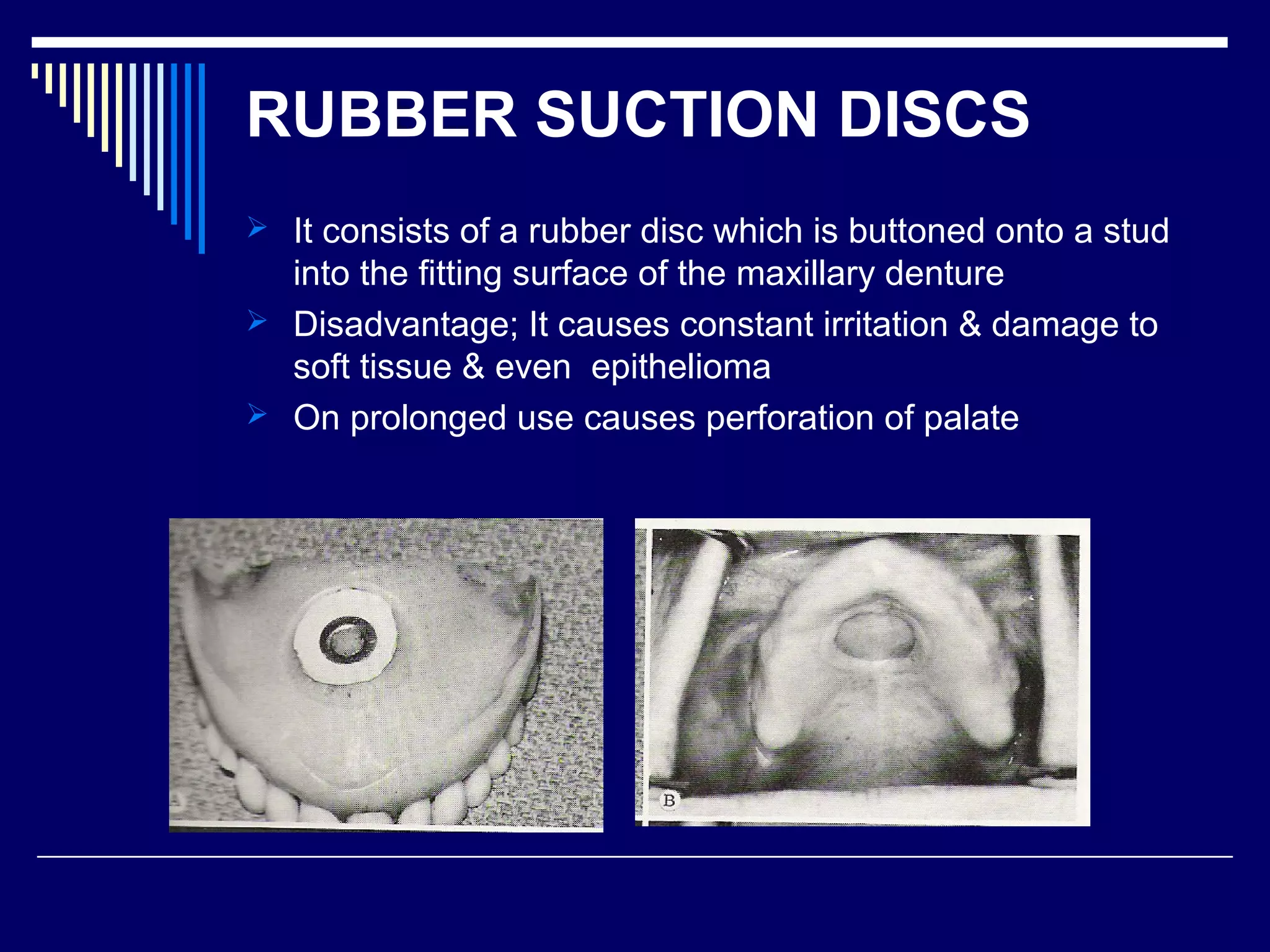 RUBBER SUCTION DISCS
 It consists of a rubber disc which is buttoned onto a stud
into the fitting surface of the maxillary denture
 Disadvantage; It causes constant irritation & damage to
soft tissue & even epithelioma
 On prolonged use causes perforation of palate
 