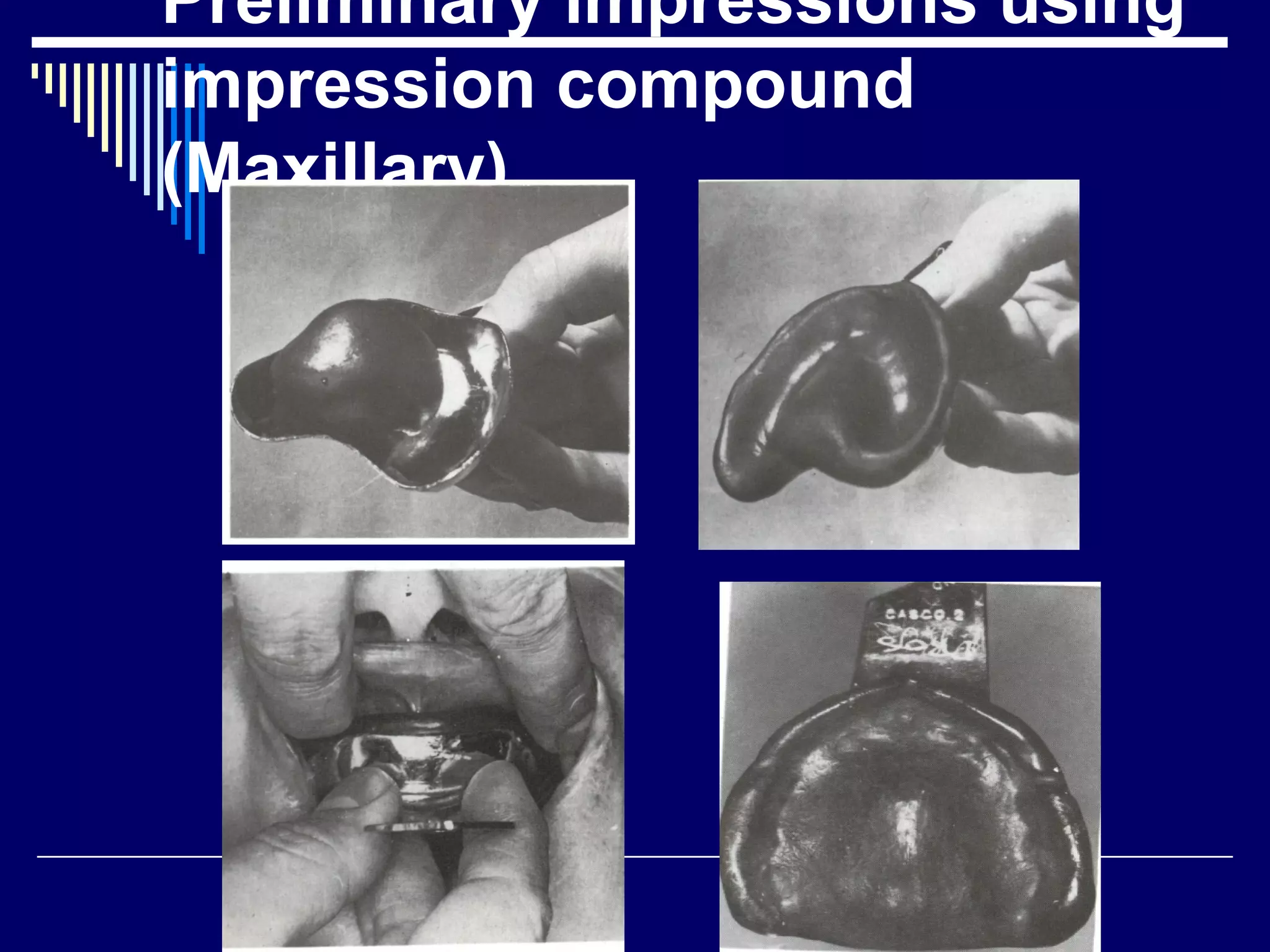 Preliminary impressions using
impression compound
(Maxillary)
 