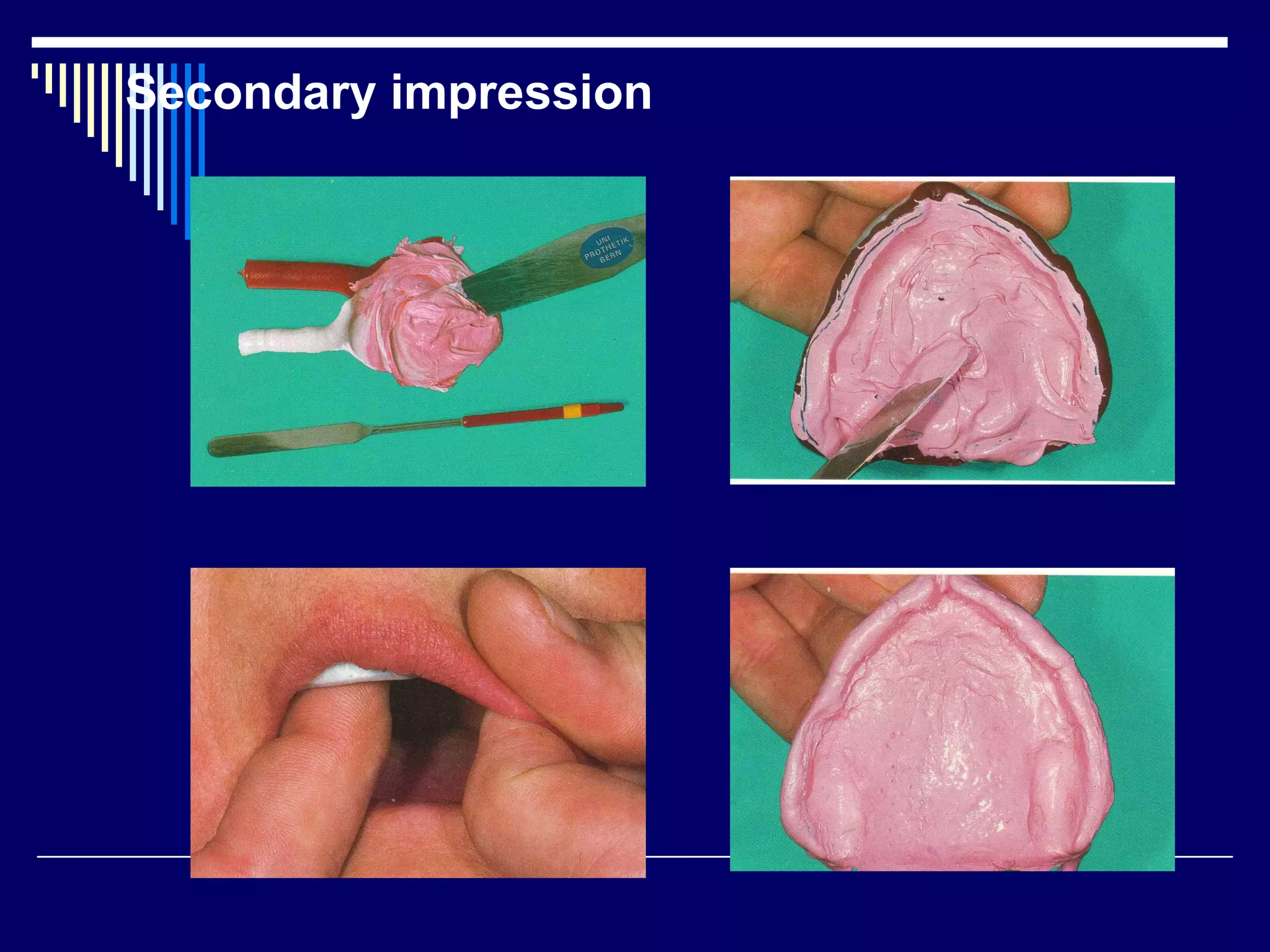Secondary impression
 