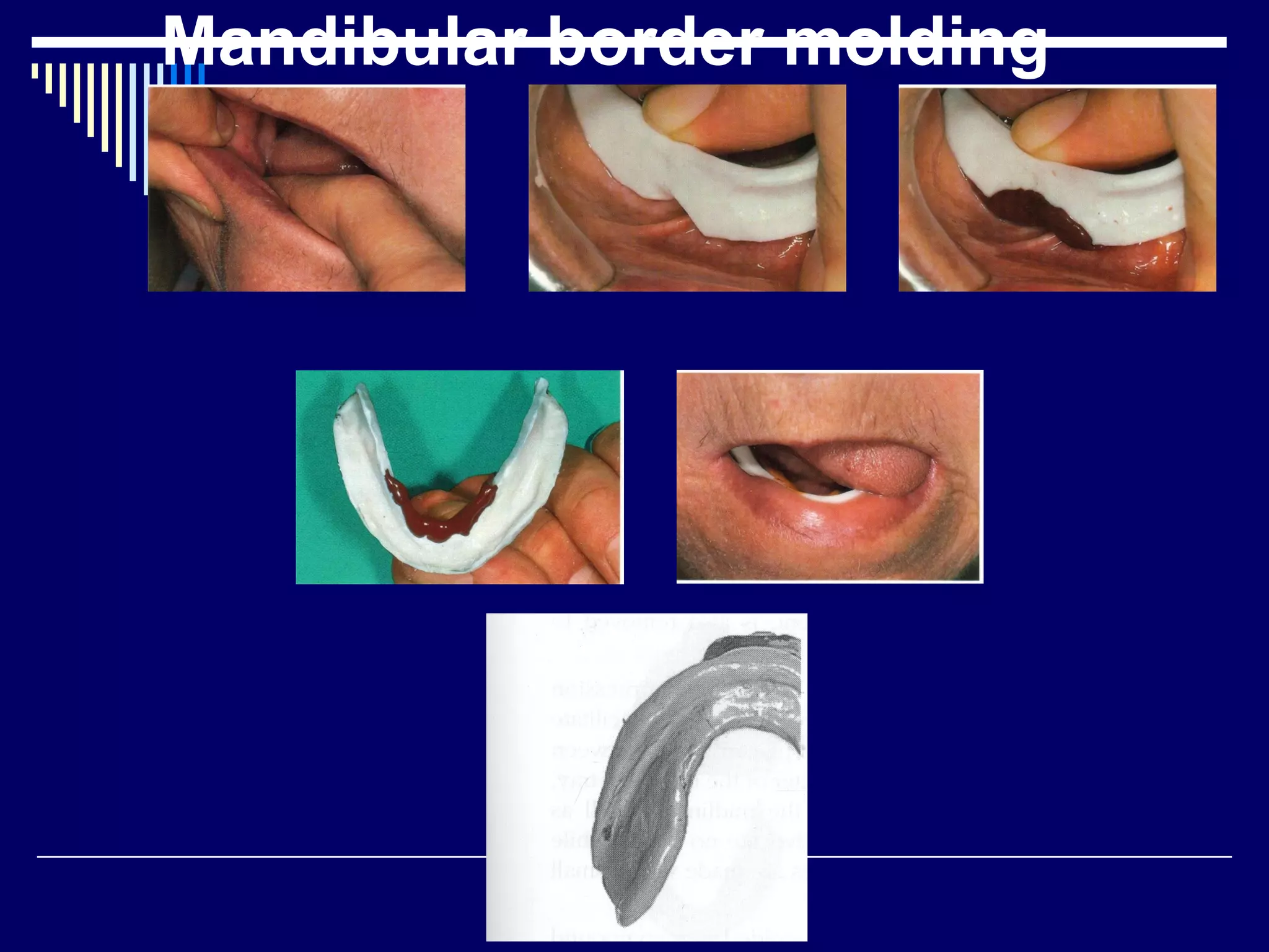 Mandibular border molding
 