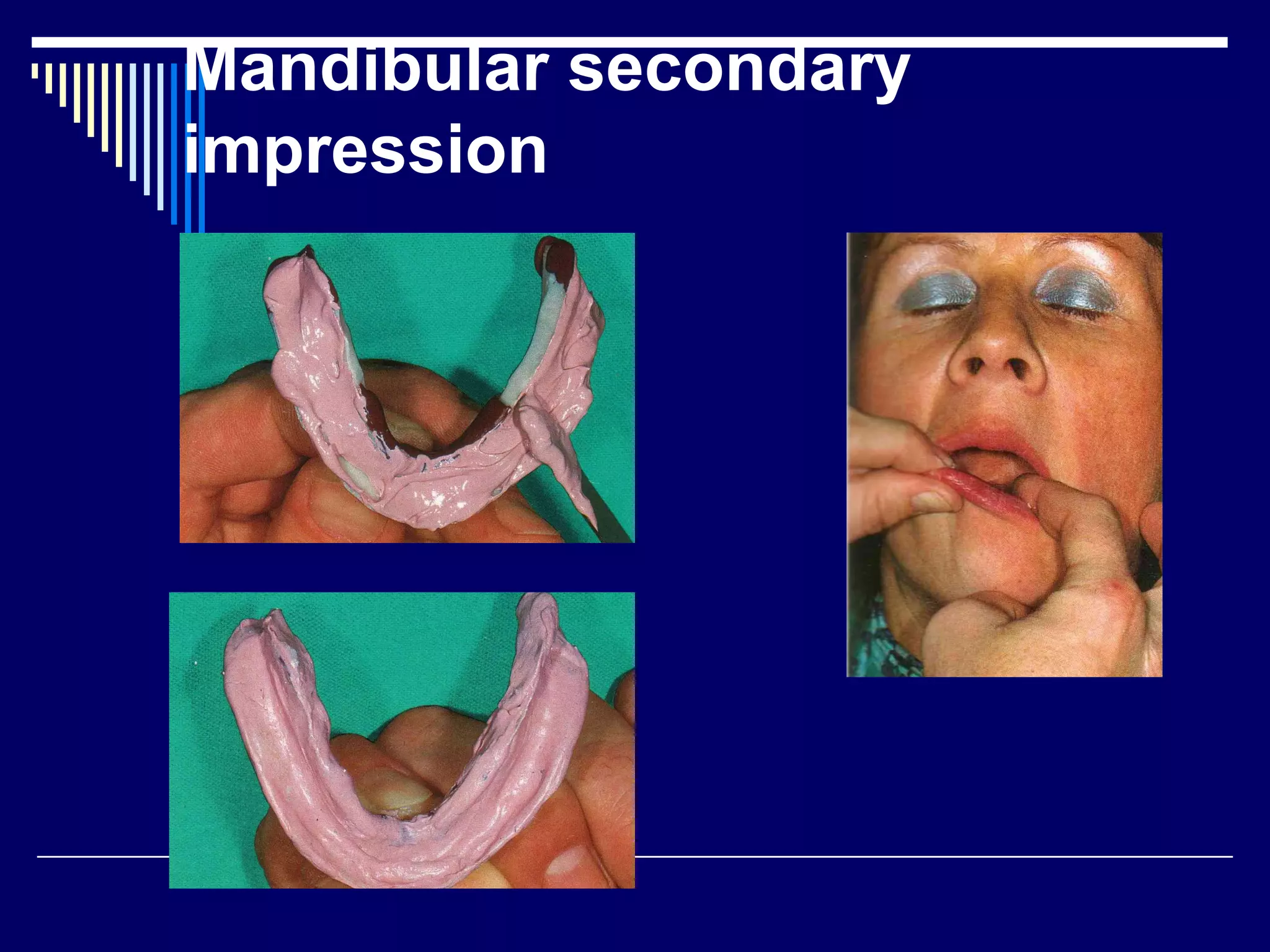 Mandibular secondary
impression
 