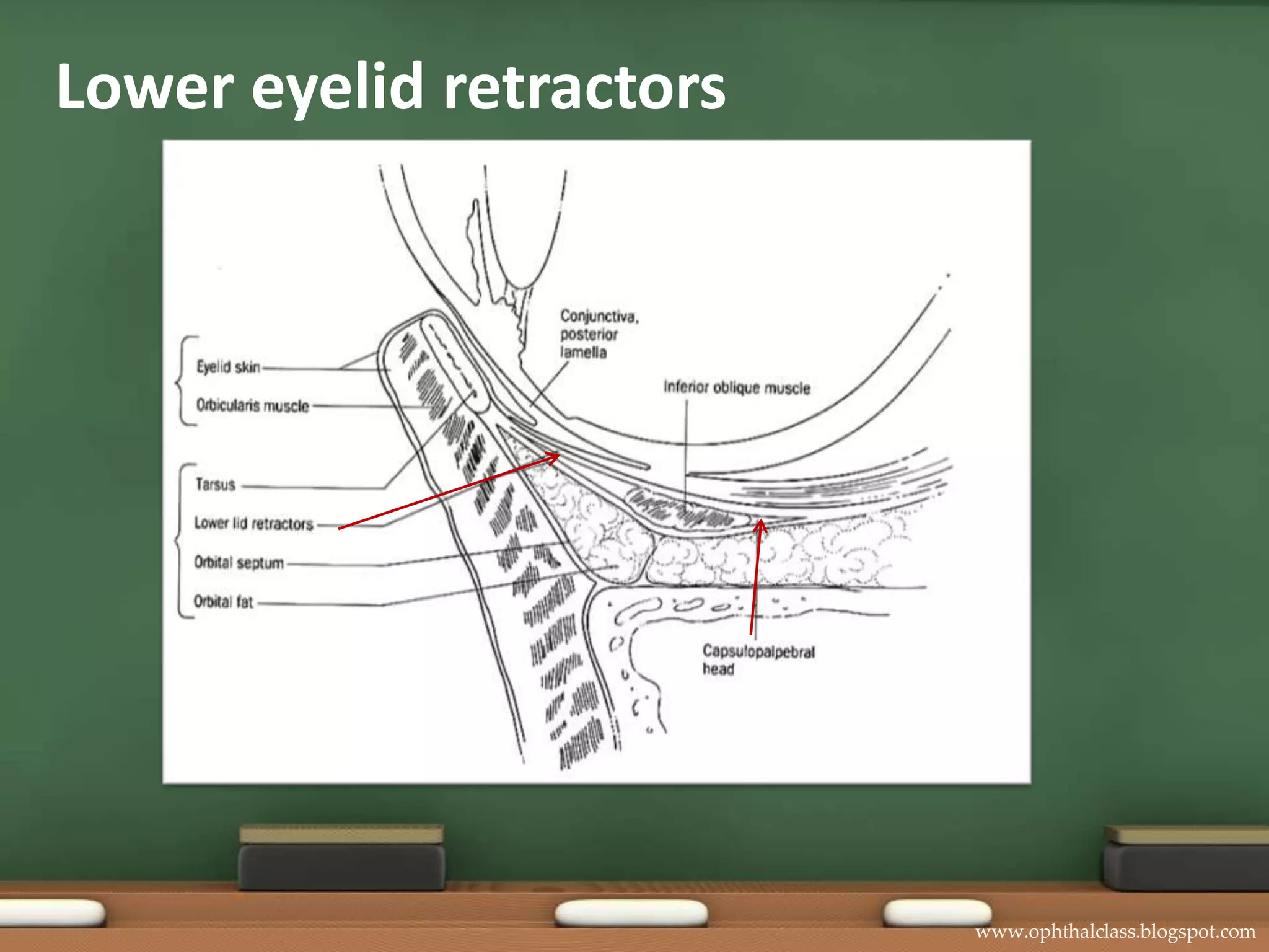 Lower eyelid retractors