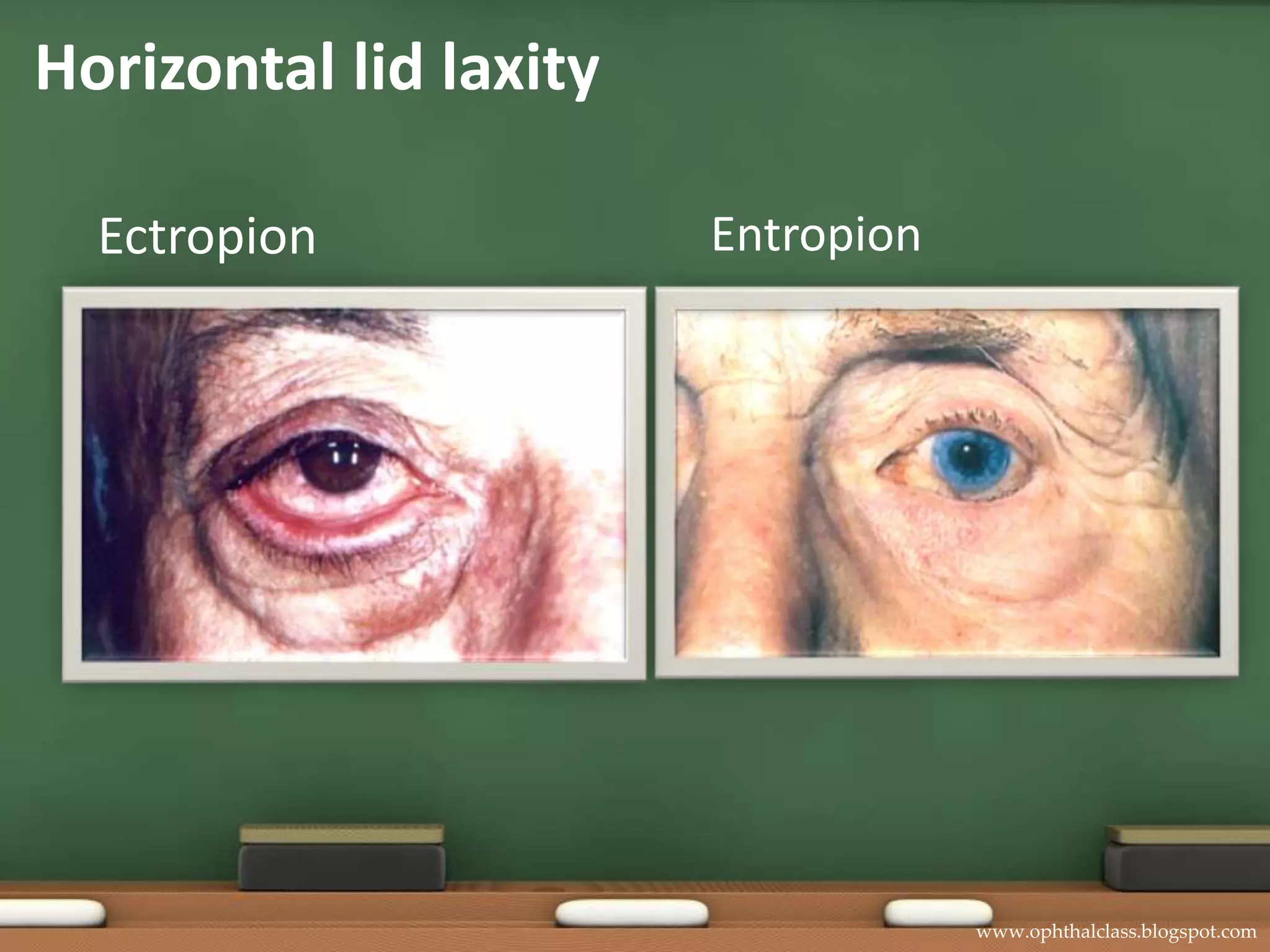 Age related lid laxity