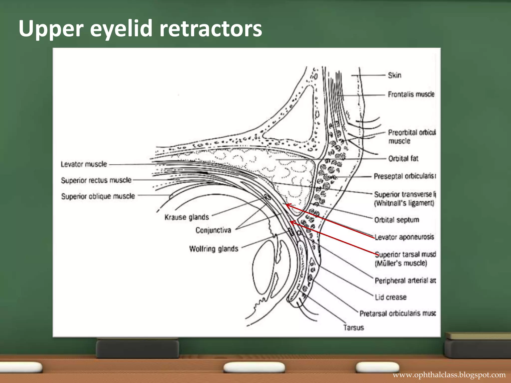 Upper eyelid retractors