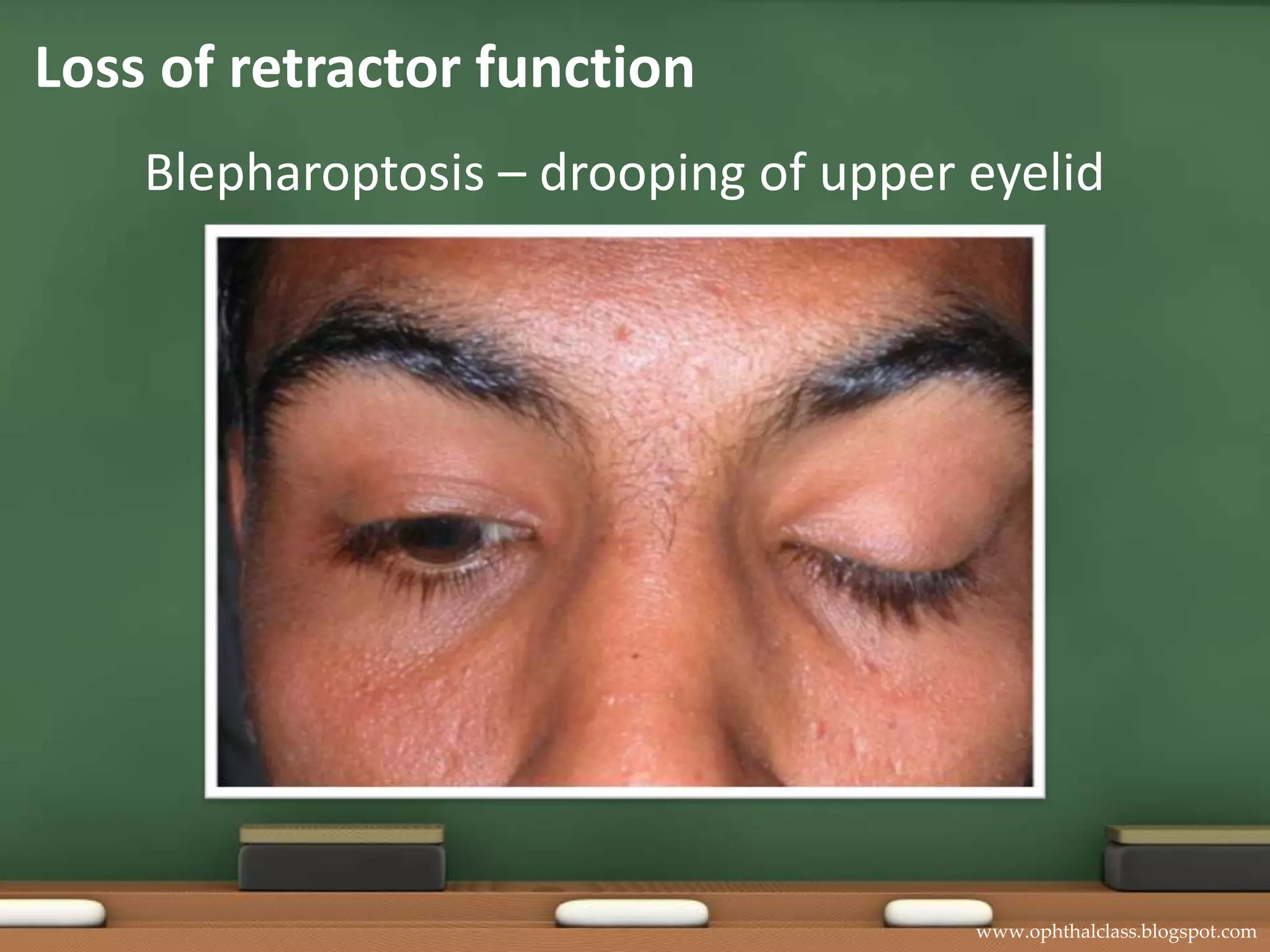Loss of retractor functionBlepharoptosis – drooping of upper eyelid