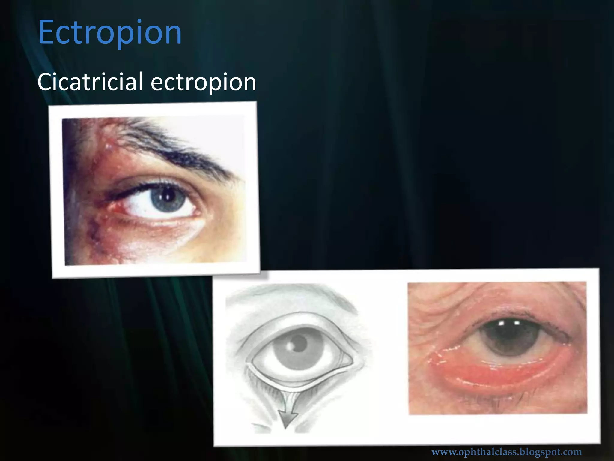 Paralytic ectropionEctropionFacial palsy
